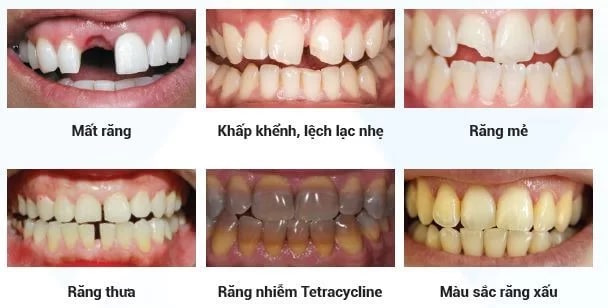 6 trường hợp nên bọc răng sứ thẩm mỹ