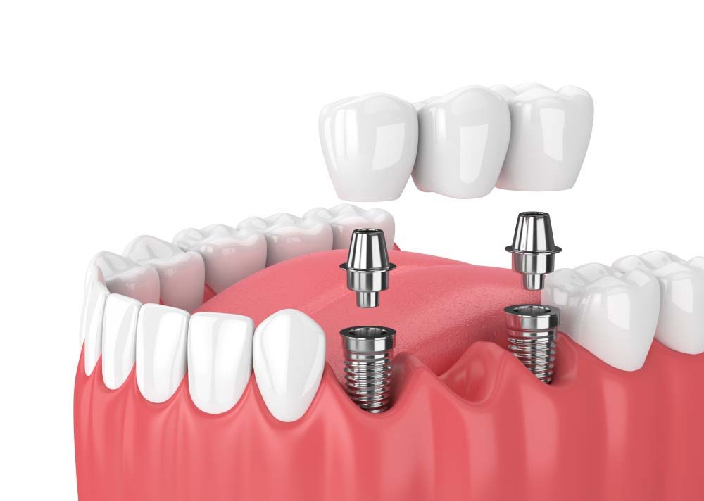 Cầu răng sứ trên Implant