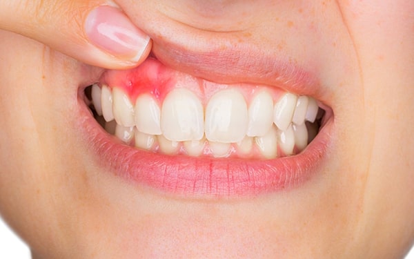 Bọc răng sứ có thể gây viêm nướu