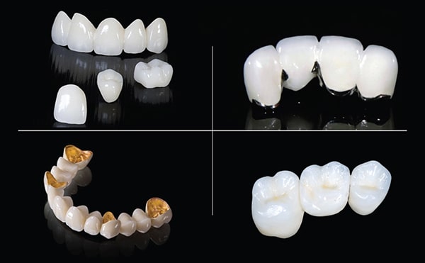 Bọc răng sứ an toàn và chất lượng phụ thuộc vào những yếu tố nào?