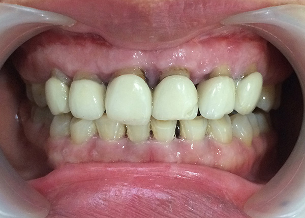 Nướu răng bị đổi màu khi bọc răng sứ