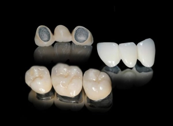 Có nên bọc răng sứ kim loại không?
