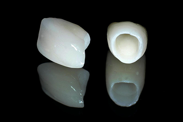 Răng sứ titan loại sứ tốt nhất của dòng sứ kim loại