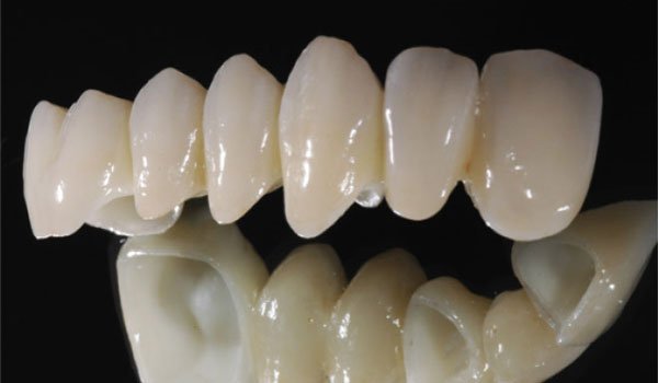 Răng sứ cercon được nhiều khách hàng lựa chọn