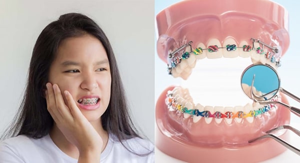 Niềng răng cho hô hàm có đau không?