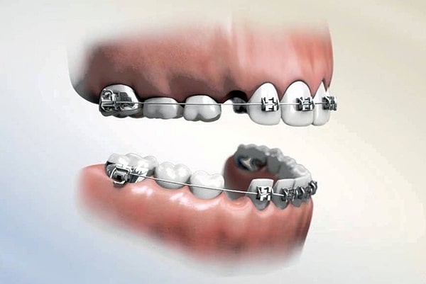 Giai đoạn nhổ răng để tạo khoảng cách cho dịch chuyển răng