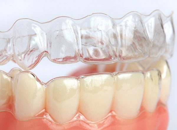 Niềng răng không mắc cài 3D Clear có tốt không?