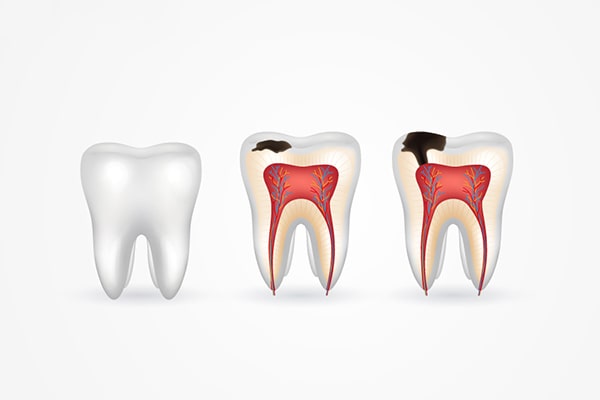 Ngăn ngừa sâu răng và bệnh nướu răng