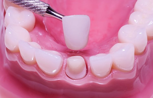 Những ưu điểm của bọc răng sứ