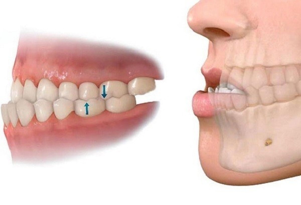 Biểu hiện của tình trạng móm răng